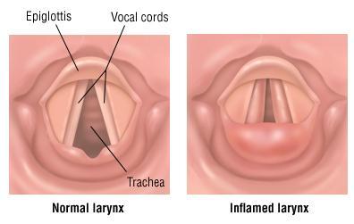 airways that causes a cough