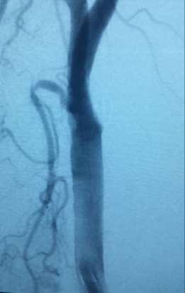 AP and Lateral Imaging Confirms Sheath Position AP View Arterial Sheath