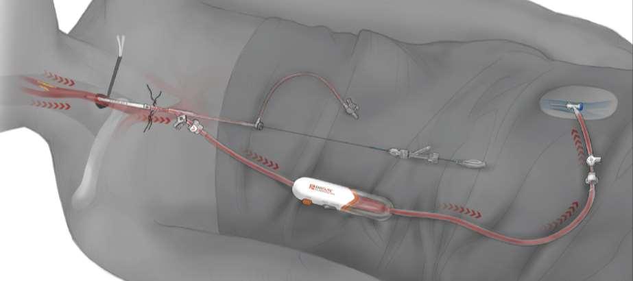 Final Setup of the ENROUTE NPS Working channel for interventional devices ENROUTE Transcarotid Stent System (57cm) Blood flow is returned