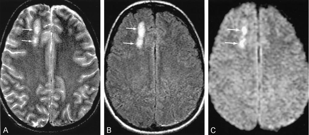 Minimal parenchymal contusions in a 36- year-old patient admitted after a head injury. Axial images show intraparenchymal contusions (arrows) in the right frontal lobe. A, T2-weighted image.