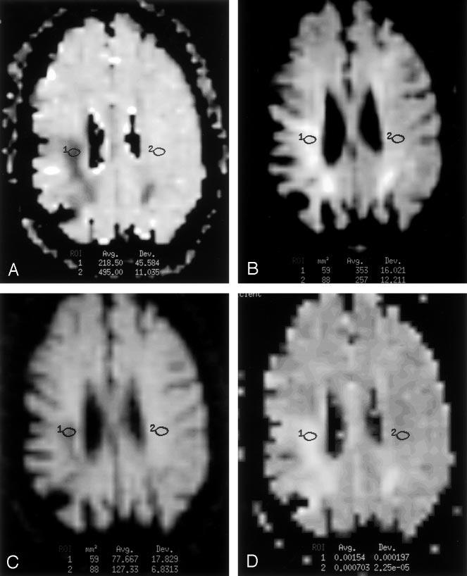 AJNR: 24, April 2003 INFARCT SIGNAL INTENSITY 685 FIG 6. Images in a 74-year-old man with an onset of left-sided weakness 90 days before imaging.