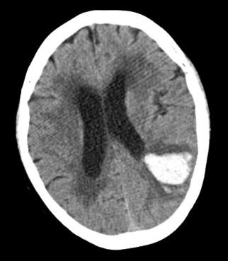 SO HEE PRK ET L Fig. 1. xial non-contrast brain computed tomography shows an intracerebral haemorrhage on left parieto-occipital area.