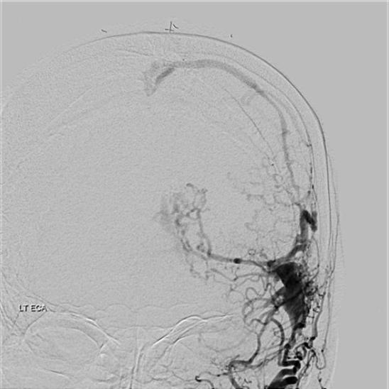 Consequently, a transarterial embolization via the left middle meningeal artery and left occipital artery endeavoured. However, access through the occipital artery failed.