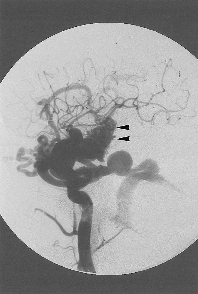 C.B. Luo, W.Y. Guo, M.M.H. Teng, et al Combined endovascular treatment and GKRS for associated arteriovenous fistula (AVF) and CAVM has not been previously reported.