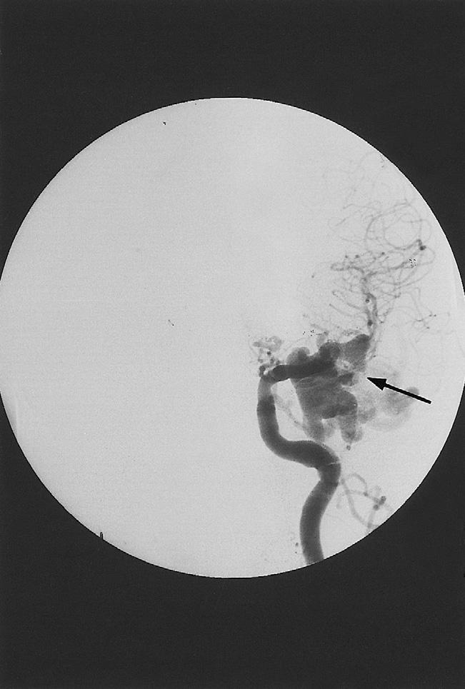 Arteriovenous fistula after radiosurgery for multiple CAVM the radiation volume was 9 ml.