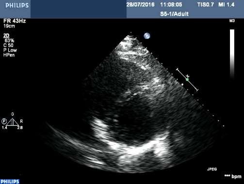 Echocardiography (ECHO): RV pulmonary hypertension, distended