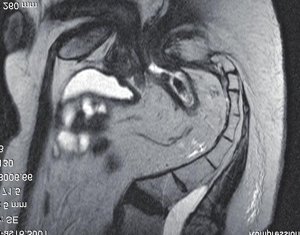 Methodology reference image. This image was considered to be representative of the site of relapse or residual tumor if the surgery was not radical.
