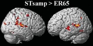 Imaging esults (andom-effects analysis) fo the diect compaison between STsamp and ER65 (P < 0.05, coected fo multiple compaisons, FDR).