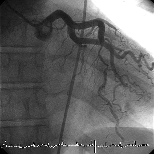 Spontaneous coronary artery dissection Look for renal,