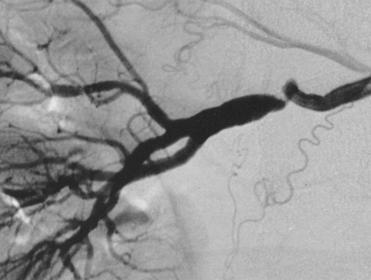 Angiographic classification of renal artery FMD String of beads Multifocal Focal