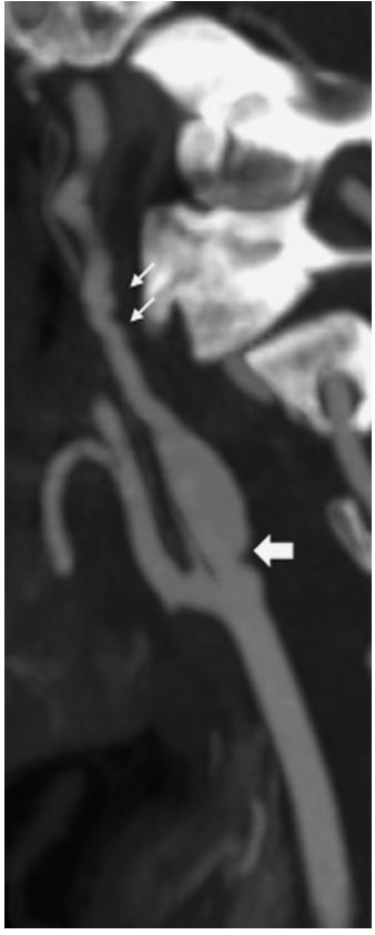Angiographic classification of FMD of the supra-aortic trunks String of beads