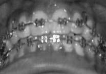 retainer Mandible: Cuspid to cuspid retainer (or premolar to premolar) is made and placed just after the band and bracket