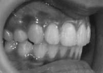 If it takes long after bands and brackets removal, not only the fitness of the retainer becomes worse but also the relapse