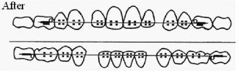 At this step, the dental arch form is almost straightened in buccolabial view. If the bracket position (height and/or angulation) is recognized to be wrong, change the bracket position immediately.