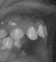 Protrusion with Proclined Incisors, Increased OB & OJ After: