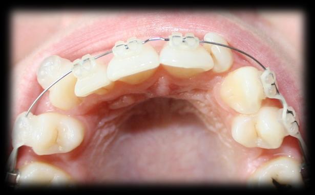 rotation Overbite reduction by