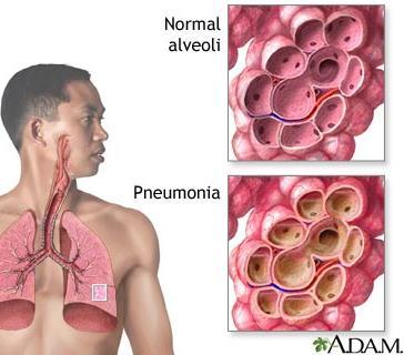 Pneumonia Inflamed alveoli filed with fluid.