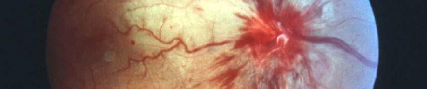 Papilledema Abnormal eye movements Fever
