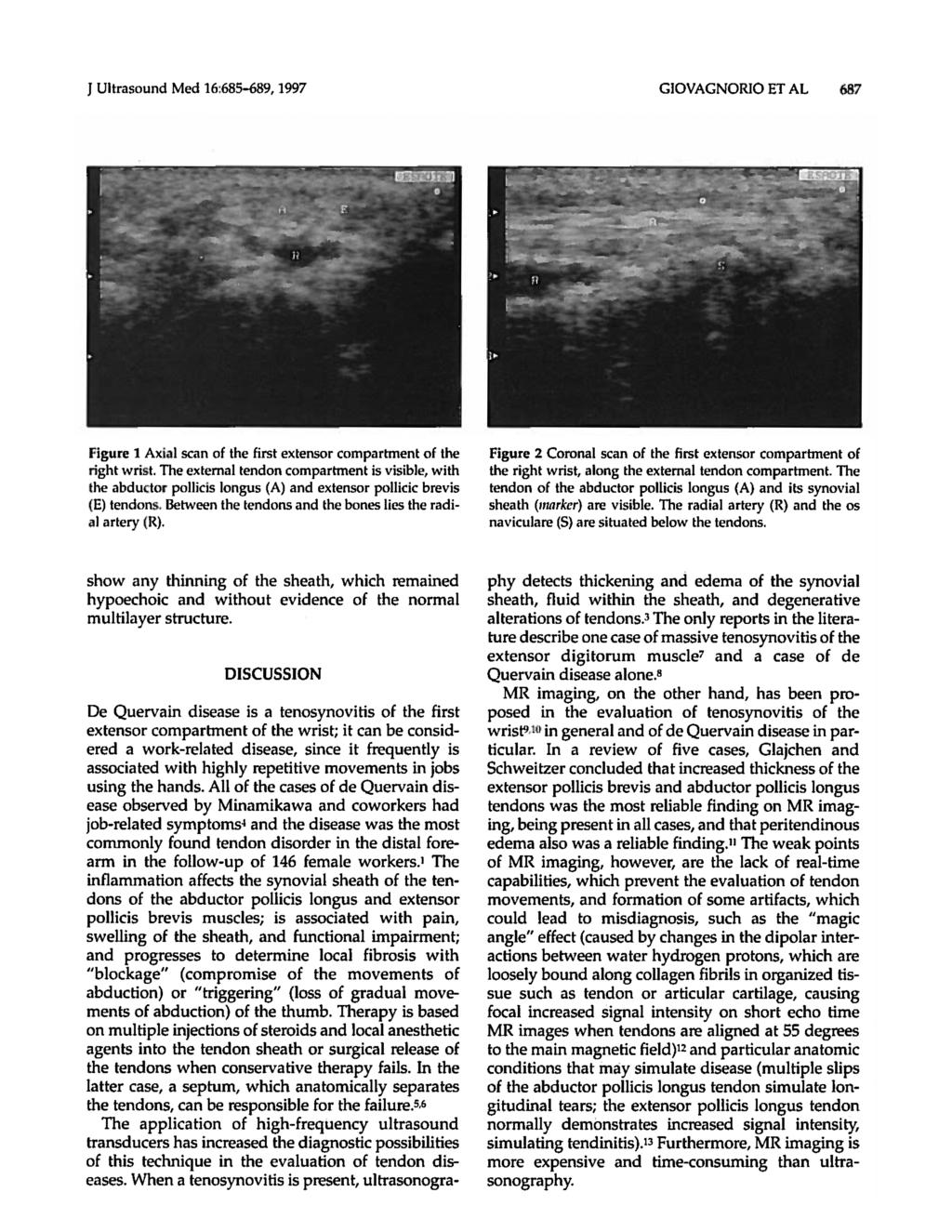 JUltrasound Med 16:685-689, 1997 GIOVAGNORIO ET AL 687 Figure 1 Axial scan of the first extensor compartment of the right wrist.