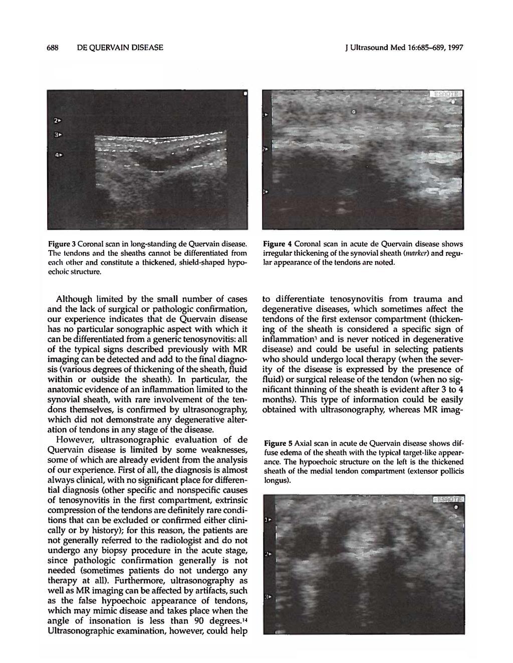 688 DE QUERVAIN DISEASE J Ultrasound Med 16:685-689, 1997 Figure 3 Coronal scan in long-standing de Quervain disease.