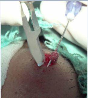 2: Melanocytic nevus being cut from base Fig.
