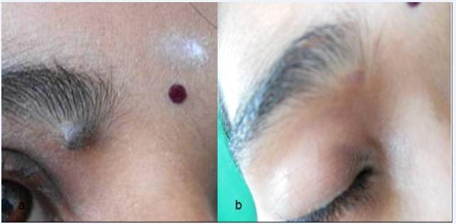 7a, b: Melanocytic nevi on the medial aspect of eyebrow healing