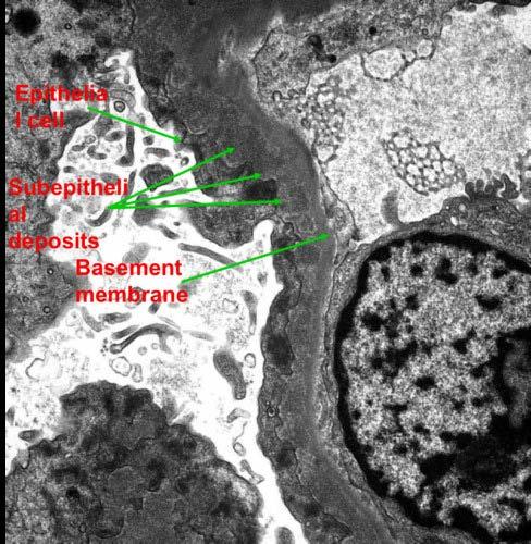 Renal biopsy Membranous glomerulonephropathy stage 1 associated with focal segmental glomerulosclerosis.