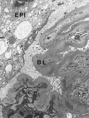 and intramembranous deposits *rare glomerular basement membrane spikes (new basement membrane material produced