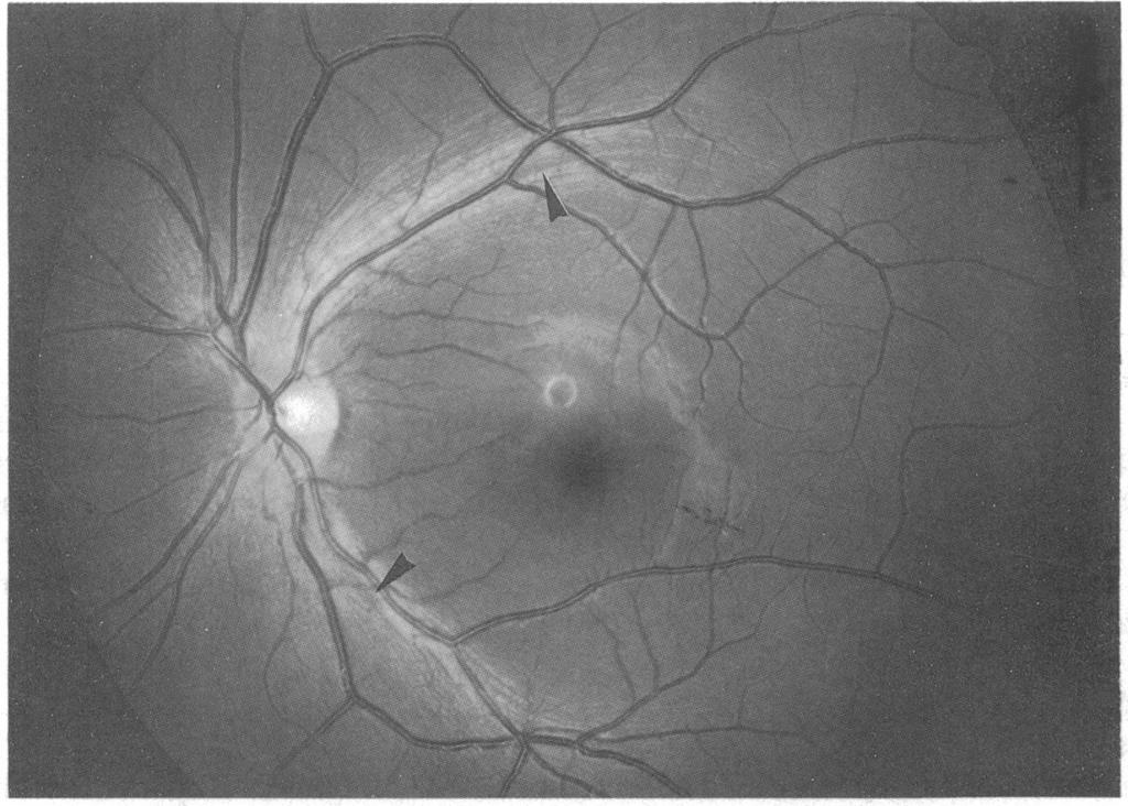 286 2Jonas, Schiro Figure I Retinal nervefibre layer photography ofa normal eye. Black arrowheads: slit-like pseudodefects. Figure 2 Retinal nervefibre layer (RNFL)photograph ofan eye with glaucoma.