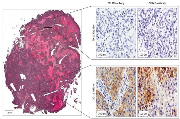 PD-L1 Expression Can Vary Between Primary And Metastasis, Different Metastases, and Within One Tissue Sample Variation of PD-L1 Expression Within One
