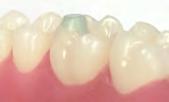 5mm which is a superior alternative when preventing any possible trauma to the incisors.