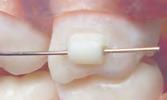 Use on the gingival of molar to hold a retainer clasp from