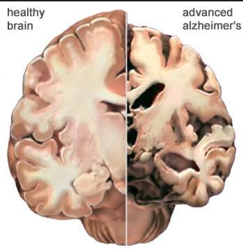 Alzheimer s Type Most common.