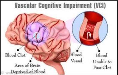 Vascular Sudden onset if caused by an acute, specific event such as a stroke or transient ischemic attack where the