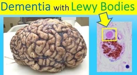 Lewy Body Intensity of symptoms may fluctuate from day-to-day. LBD is characterized by hallucinations and parkinsonian (movement) symptoms, e.g.