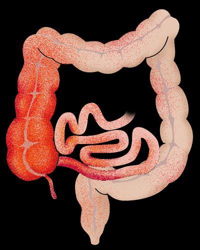Inflammatory Bowel Diseases (IBD) Chronic inflammation of the gastrointestinal tract Crohn