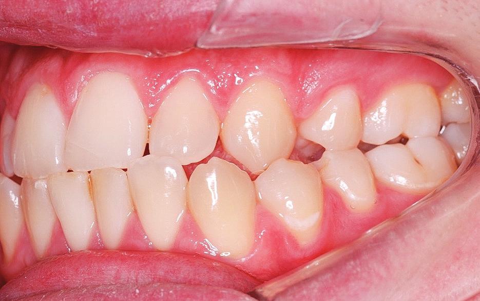 NA = 32 and 1-NA = 12 mm) and mandibular incisors (1.NB = 35, 1-NB = 8 mm, and IMPA = 112 ).