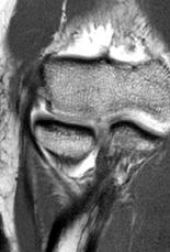 Ulna Tendon Abnormalities: Tendinosis: hypoechoic, swollen Partial-thickness tear: anechoic