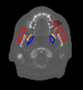 The masseters are shown in red, the medial pterygoids in blue, the lateral pterygoids in yellow, and the temporalis in magenta.