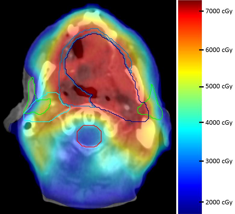 Figure 1.2: Typical head and neck VMAT treatment plan. The planning target volumes are shown by the blue contours, the parotids by the green contours, and the spinal cord by the red contour.