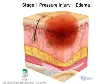 Pressure Injury Definition (NPUAP, 2016) A pressure injury is localized damage to the skin and underlying soft tissue usually over a bony prominence or related to a medical or other device.