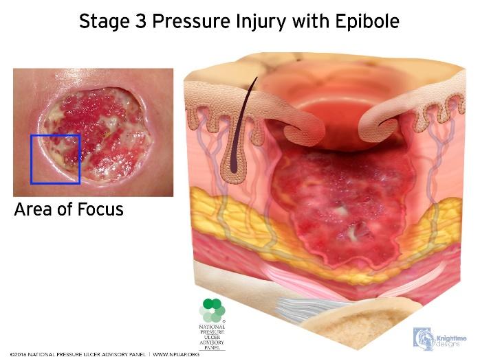 Stage 2 Pressure Injury: Partial-thickness skin loss with exposed dermis Partial-thickness loss of skin with exposed dermis.