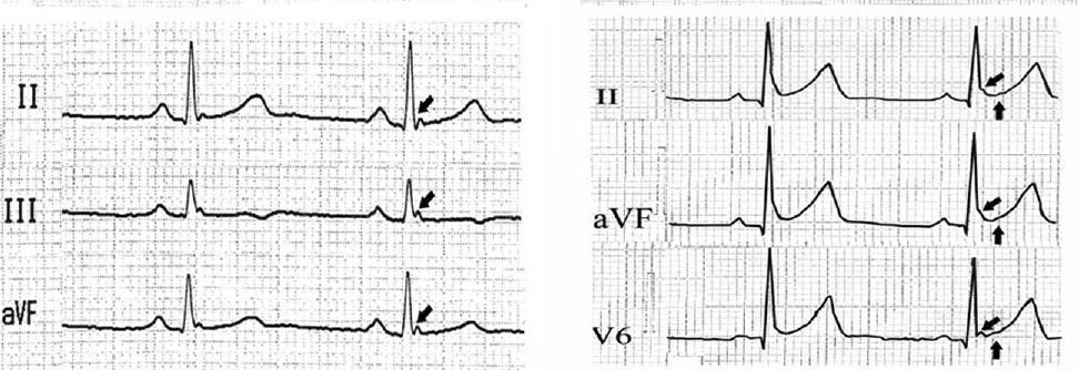 QRS slurring or J wave in the absence of ST elevation in the inferior-lateral ECG leads was associated