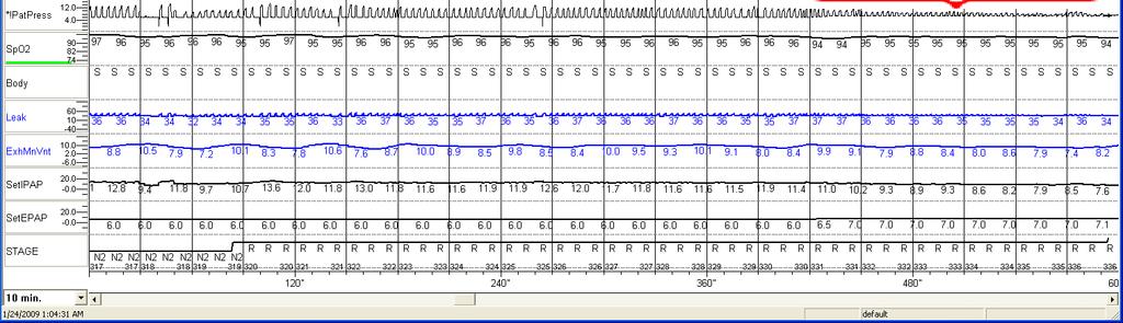 Titration Results Sleep parameters Servo ventilation study Sleep efficiency 95% Apnea-hypopnea index (episodes/hr) 3 Central apnea index (episodes/hr) 1 Obstructive apnea index (episodes/hr) 0