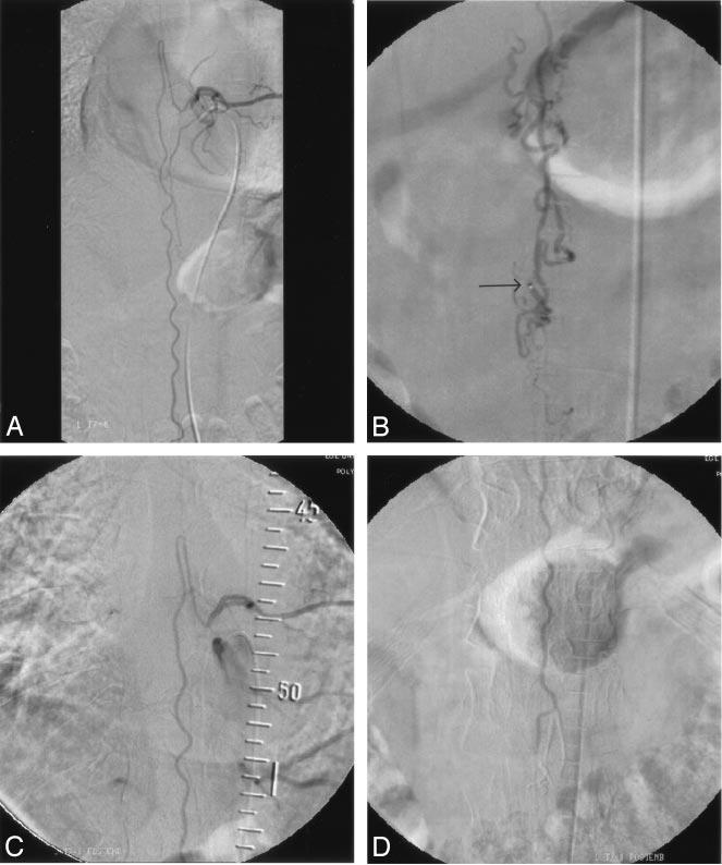 2584 ORAN AJNR: 26, November/December 2005 FIG 2. Case 1. A, Selective angiogram of left T8 intercostal artery shows slightly enlarged artery of Adamkiewicz and tortuous anterior spinal artery.