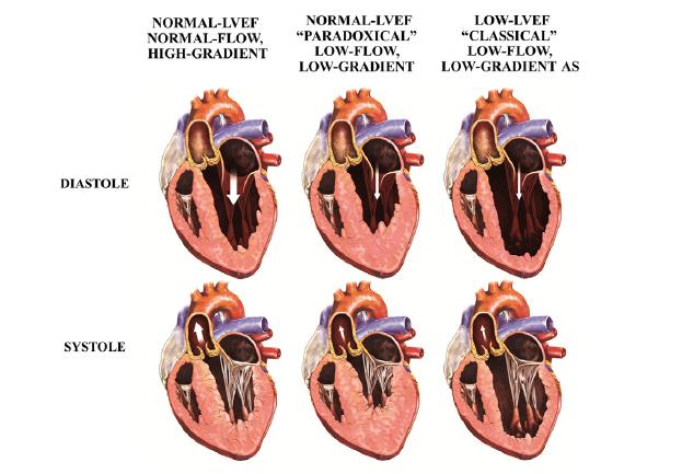 preserved LVEF - Severe concentric LVH and smaller LV cavity size - High valvuloarterial
