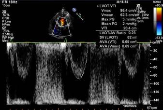 75 year old female with exertional dyspnea AV Vmax 3.