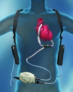 LVAD 1 year survival for LVAD DT now 80-90%