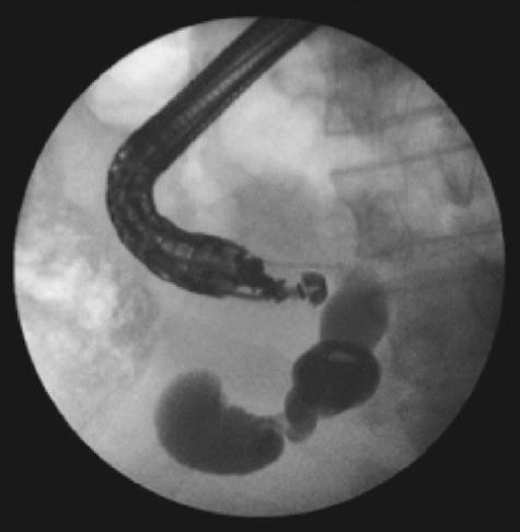(C) It shows the echo-endoscope withdrawal leaving the wire in place. (D) It shows the duodenoscope in position with the wire still in common bile duct.