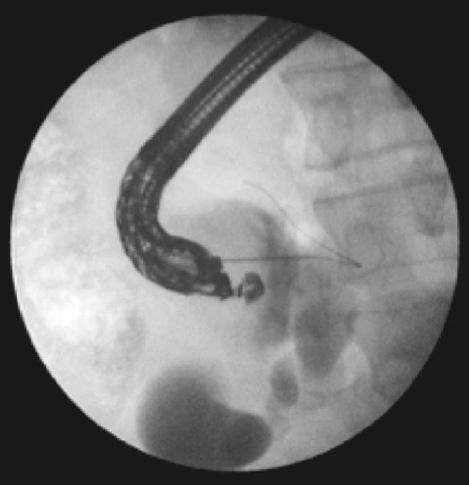 during the exchange of the scopes. In such a case, when withdrawing the echoendoscope and the FNA needle as one unit and the guidewire is exchanged till its proximal end is in the FNA needle.